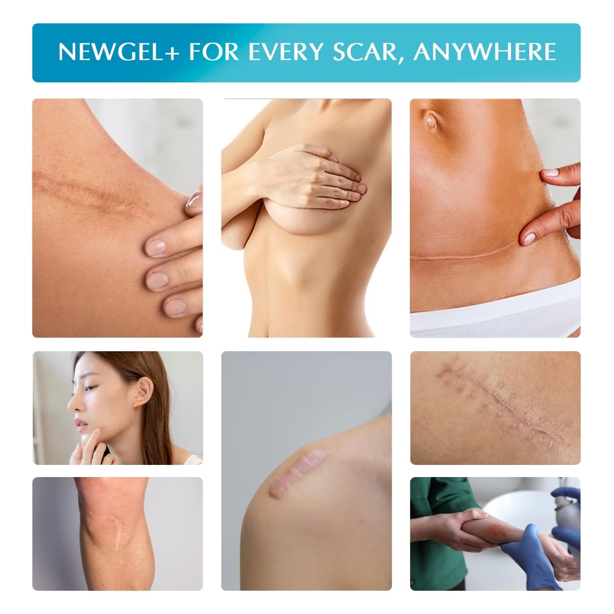 MyNewGel sheet designed for hypertrophic scars and keloids.