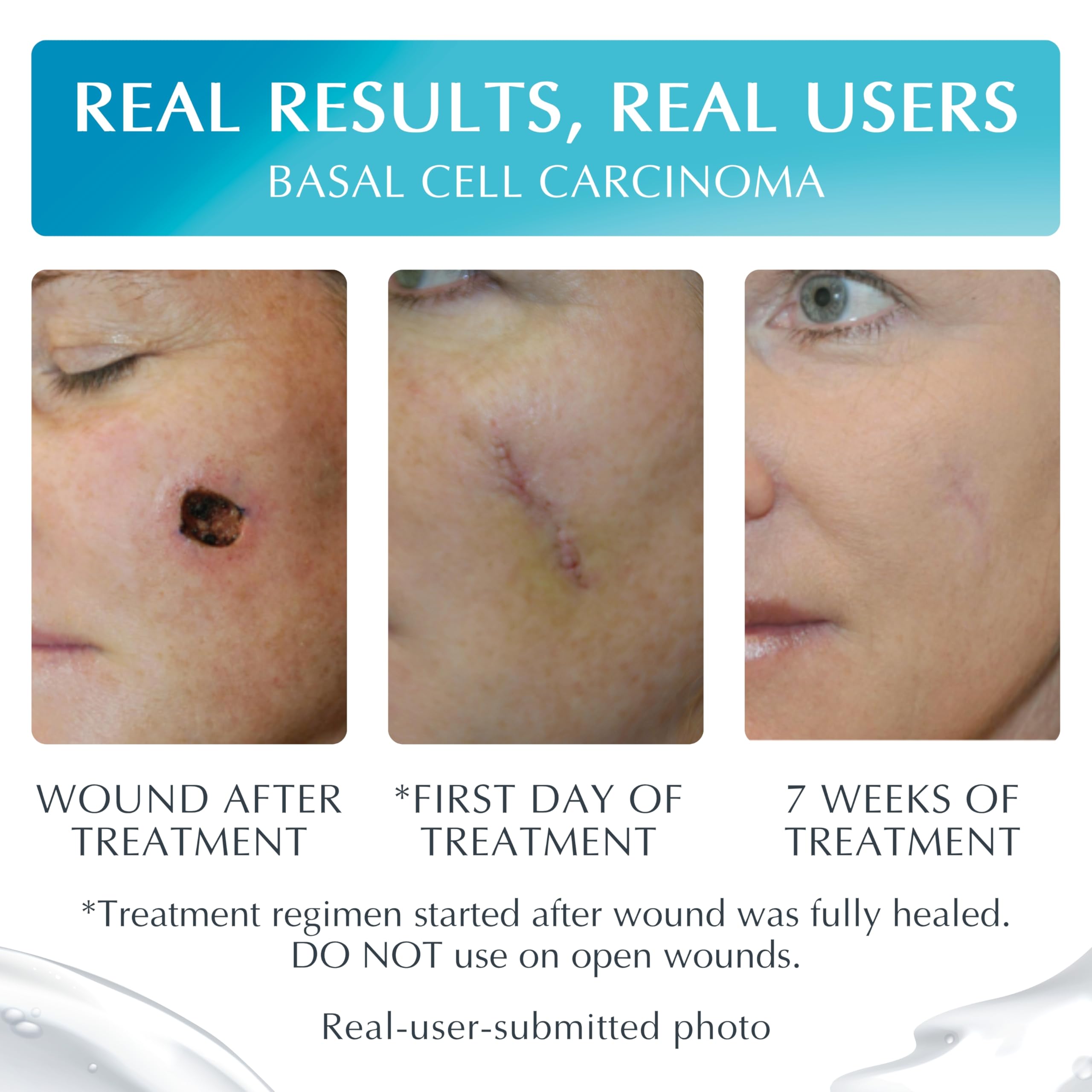 Applying the gel on a scar highlights quick-dry texture.