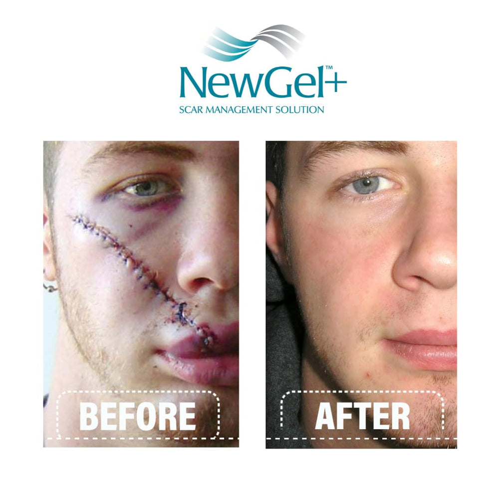 Lifestyle shot features scars from surgery and acne.