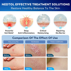 Nedtol Folliculitis Cream applied to face for gentle soothing action.