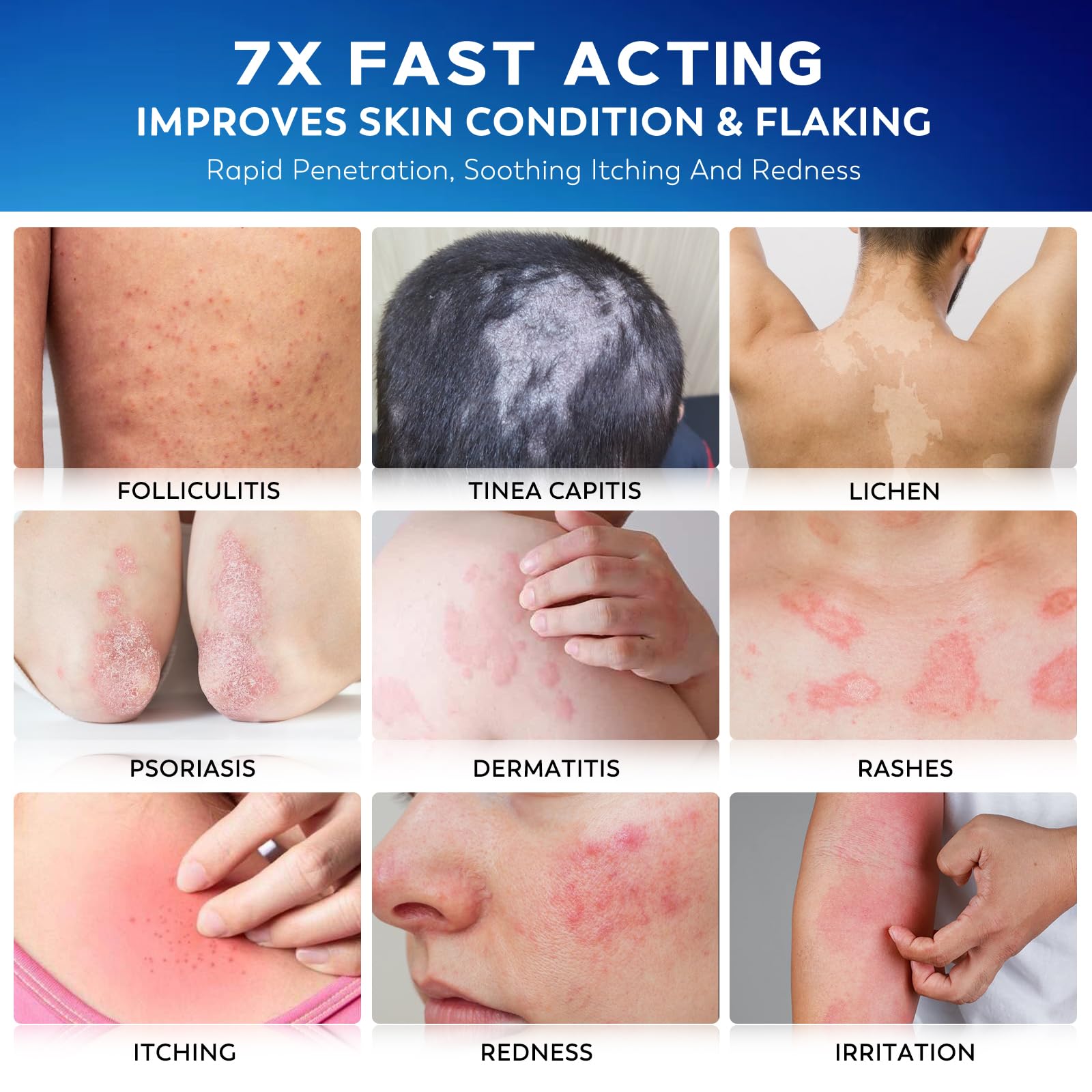 Nedtol Folliculitis Cream texture close-up highlighting non-greasy, fast-absorbing formula.