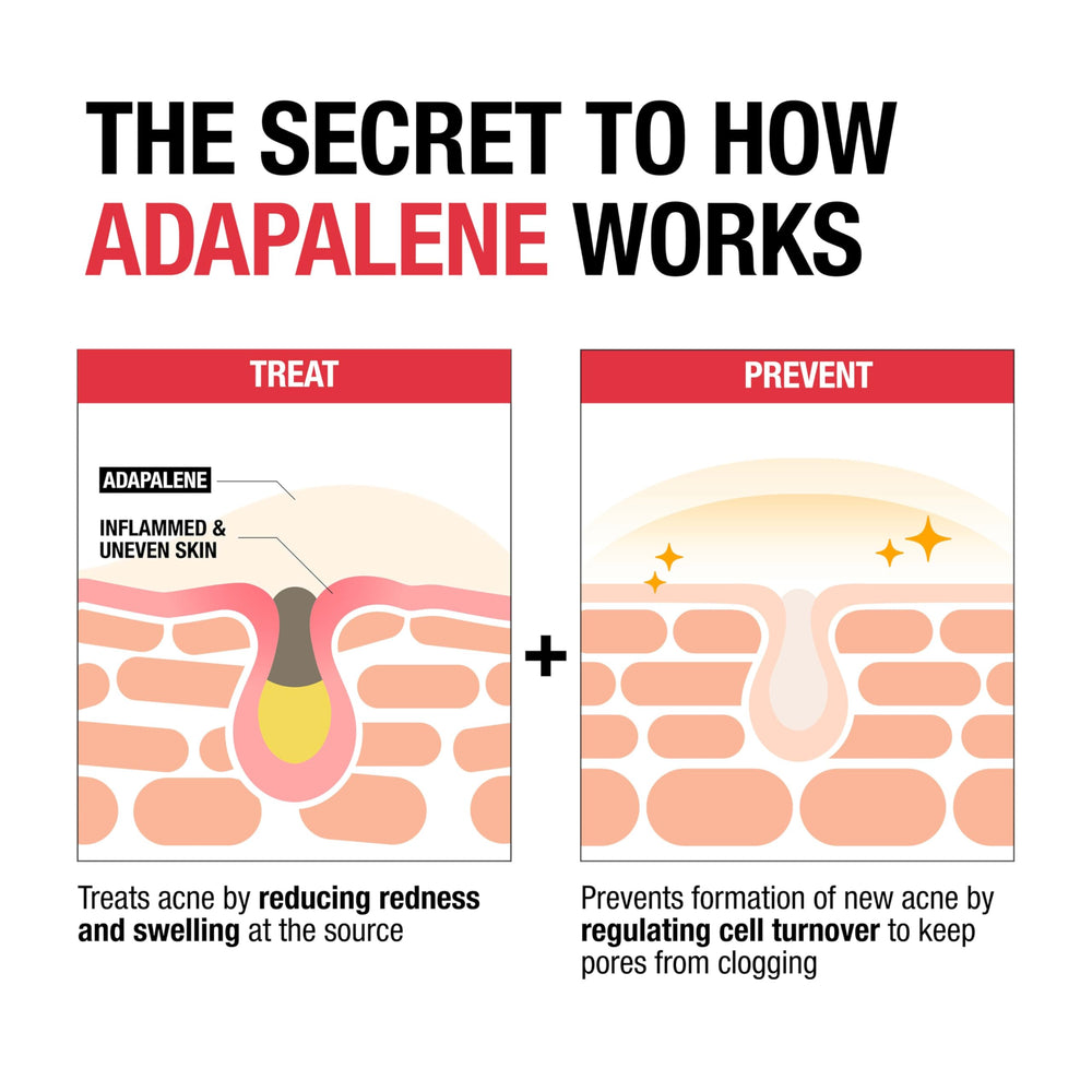 Neutrogena Adapalene Gel 0.1% on hand for convenient spot treatment