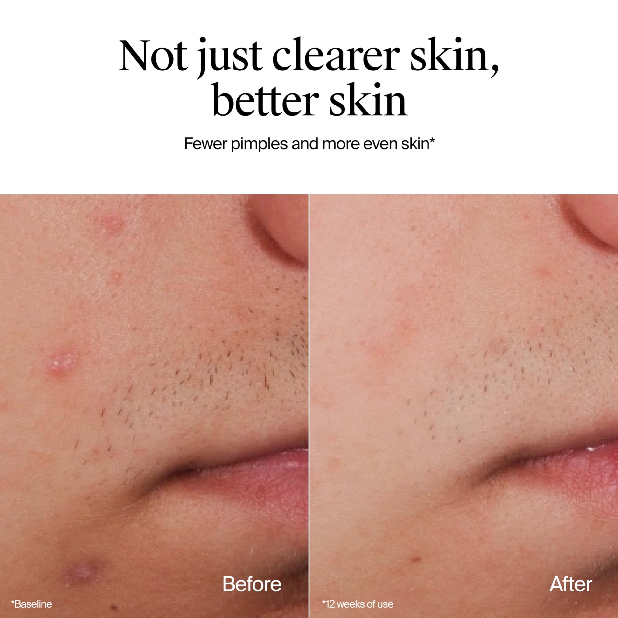 Foamy lather from Neutrogena Oil-Free Acne Wash rinsing clean.
