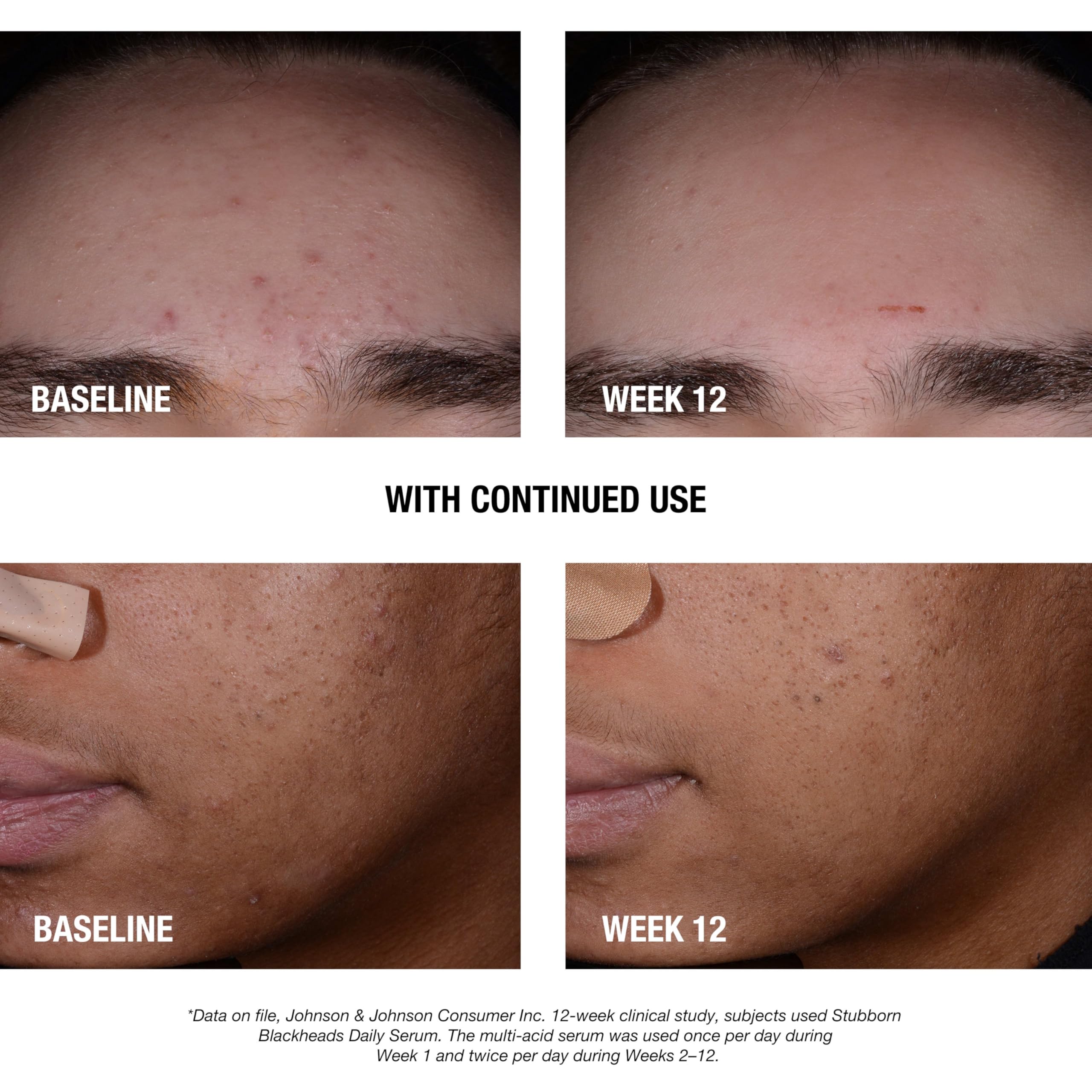 Neutrogena Stubborn Blackheads serum texture appears lightweight and fragrance-free.