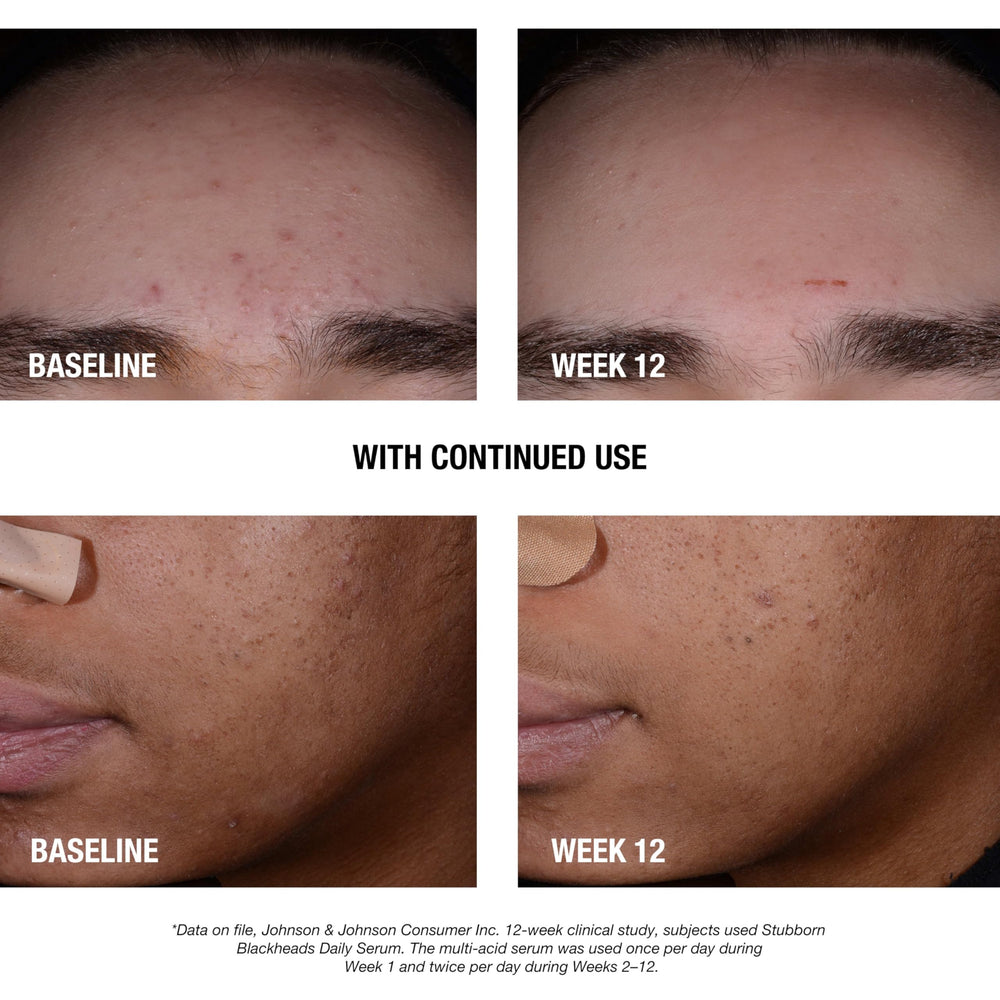Neutrogena Stubborn Blackheads serum texture appears lightweight and fragrance-free.