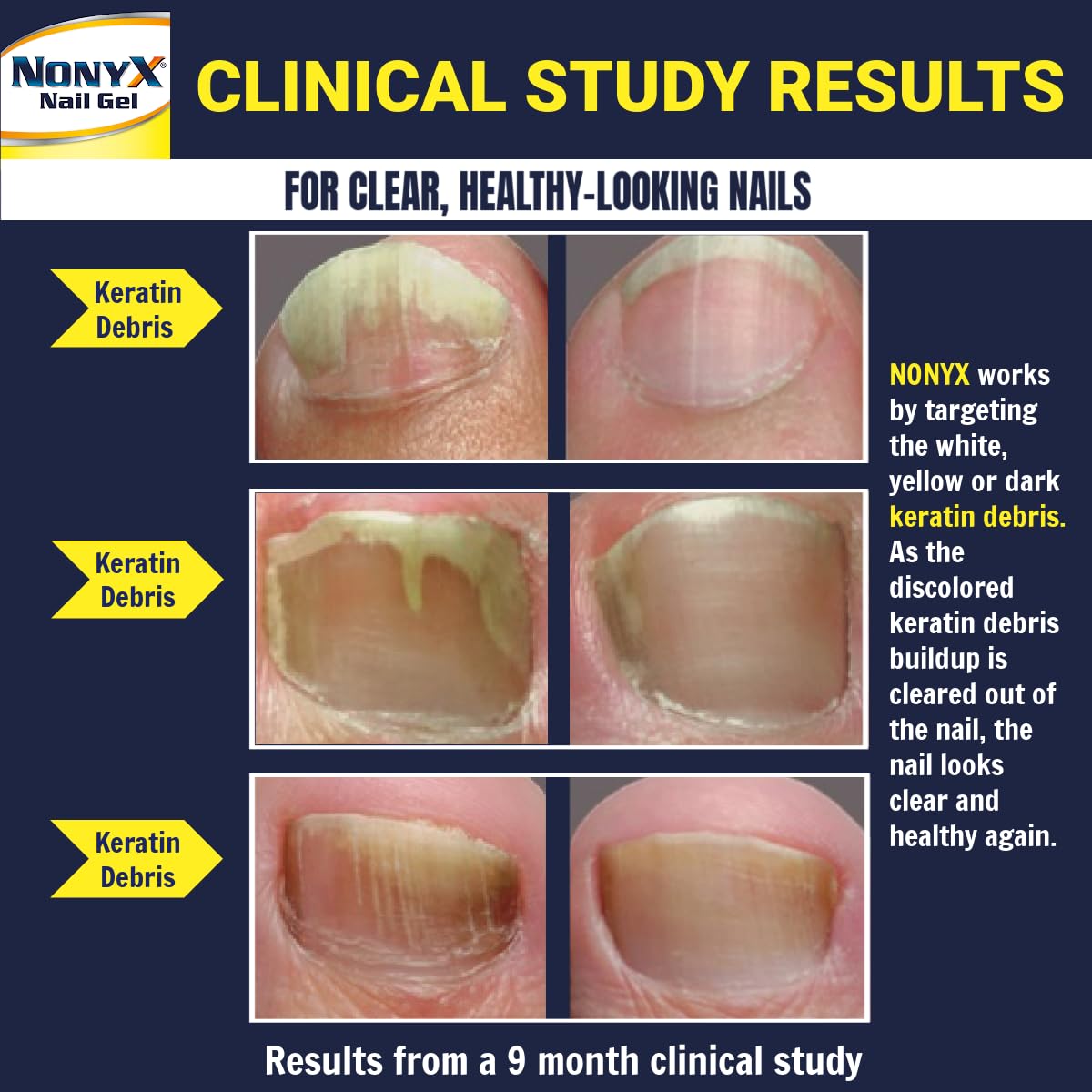 Person applying NONYX gel to address nail discoloration and texture.