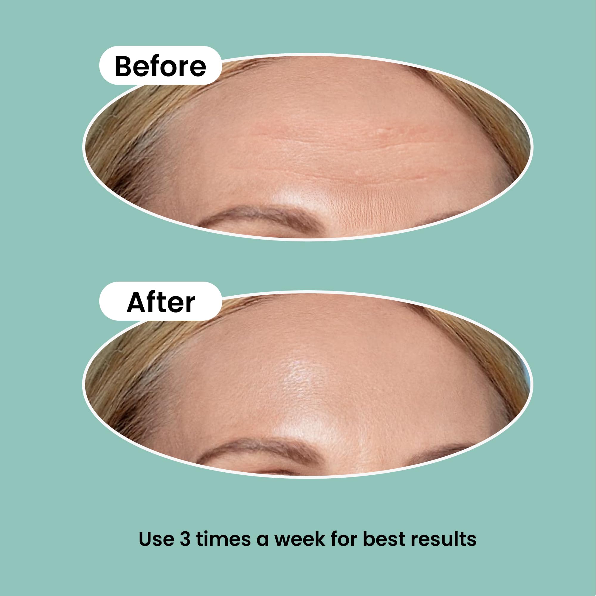 NURIVE hydrocolloid patch is designed for gentle skin contact and comfort.