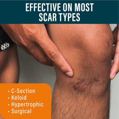 NUVADERMIS Silicone Scar Tape usage over gel area for enhanced results