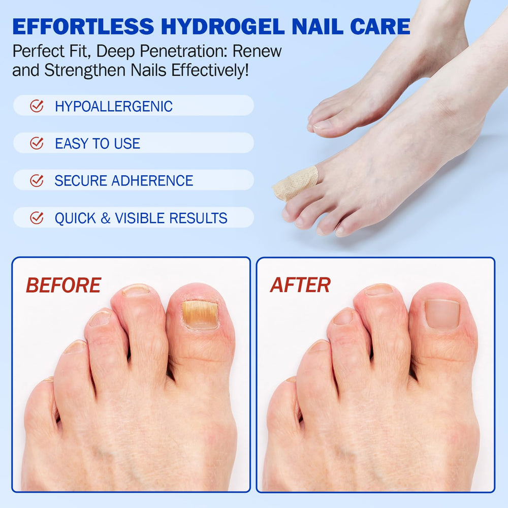 Nyloriaine nail patches are easy to apply before bedtime.