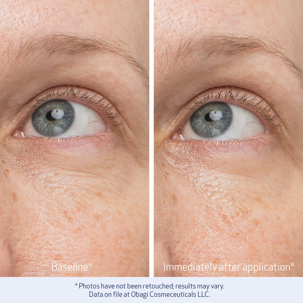Under-eye area appears brighter after gentle gel application with Obagi.