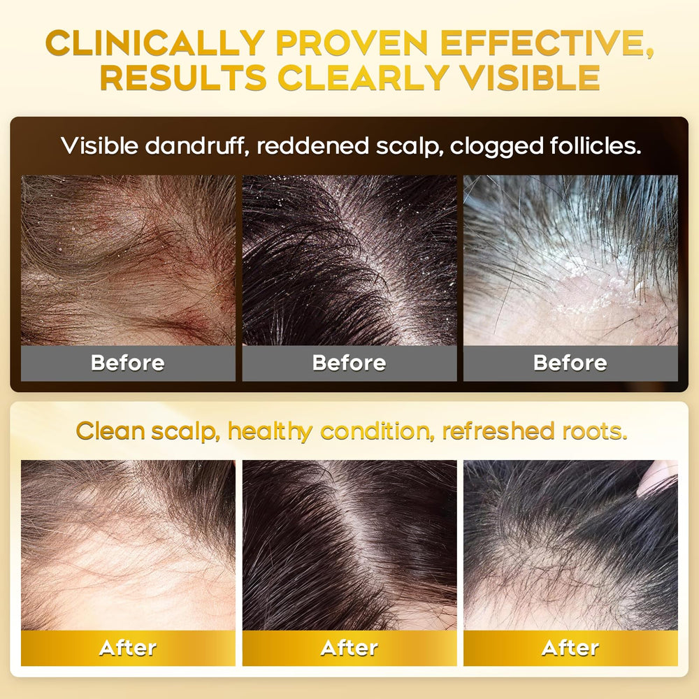 oely Enhanced Antifungal Shampoo bottle with brand tag signals trusted scalp care.