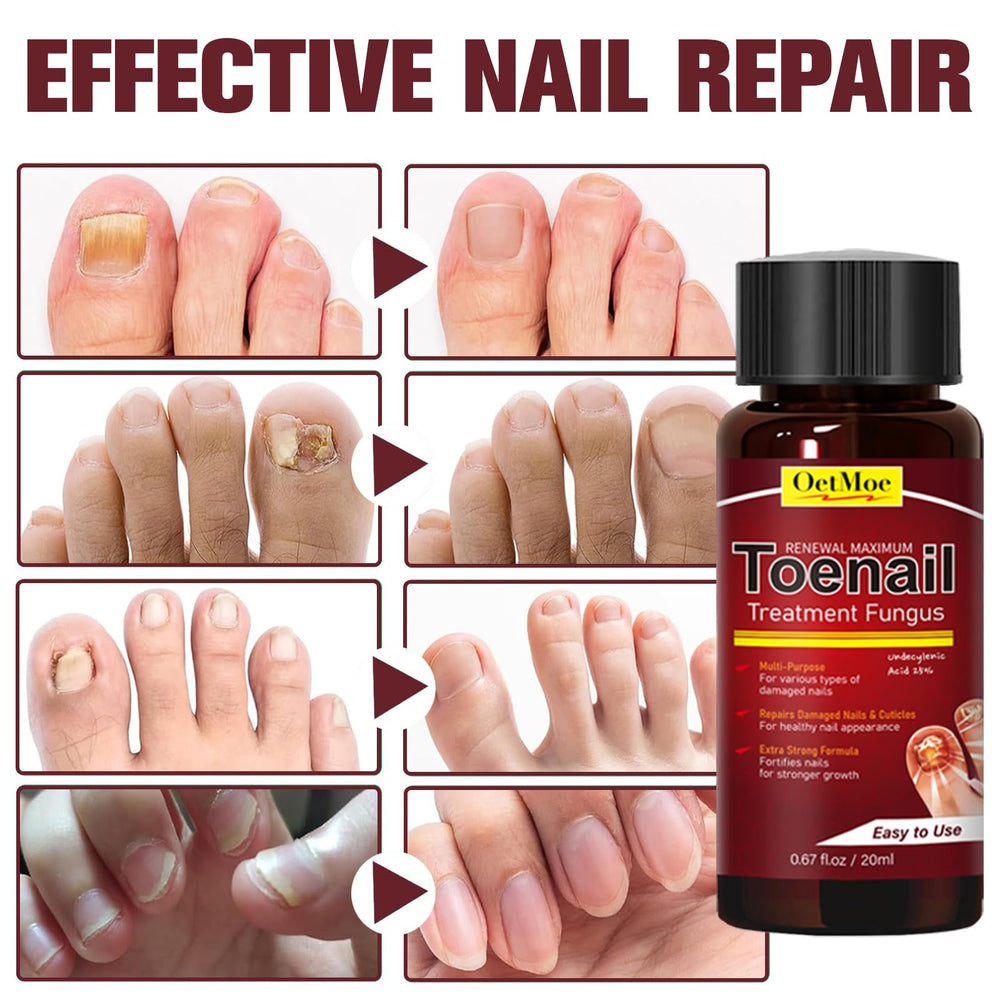 Damaged nails before treatment show yellowing and thickening