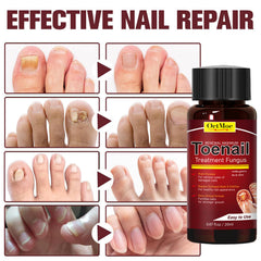 Damaged nails before treatment show yellowing and thickening