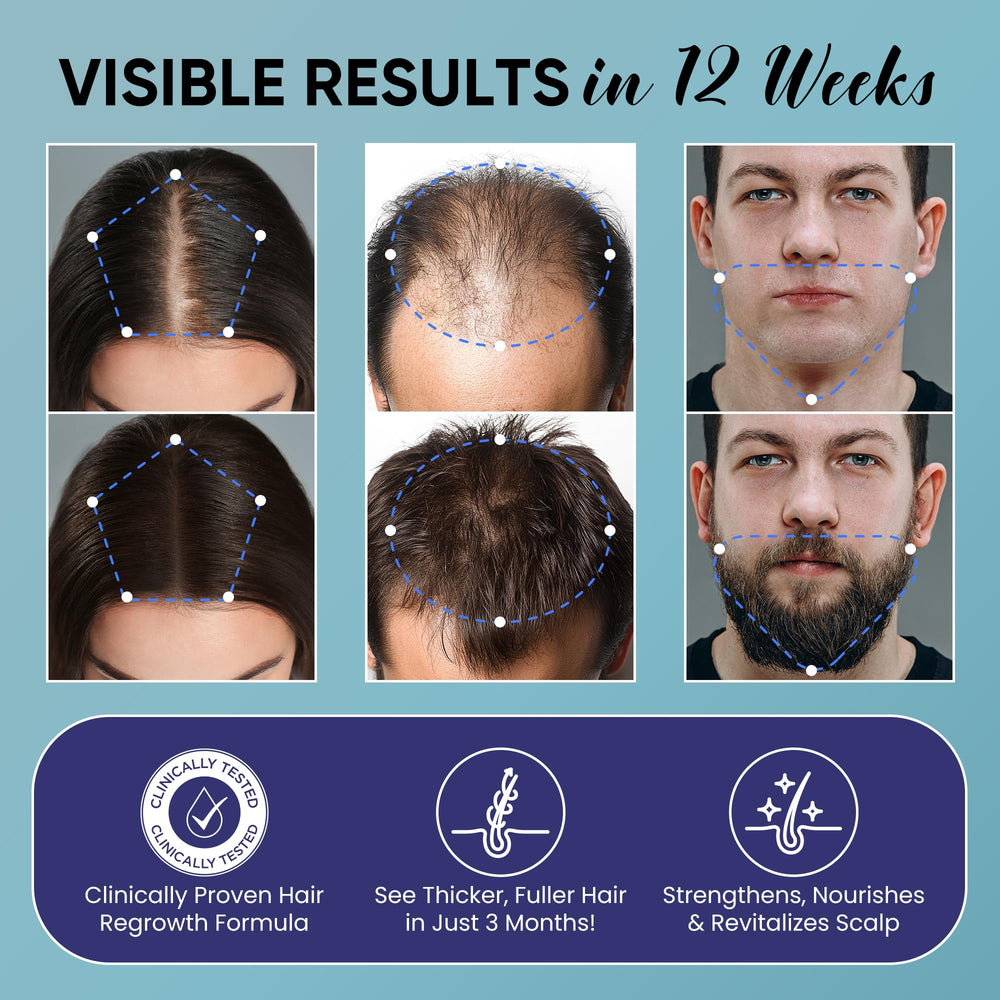 OLIVITA Minoxidil spray application enhances scalp penetration for faster coverage.