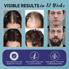 OLIVITA Minoxidil spray application enhances scalp penetration for faster coverage.