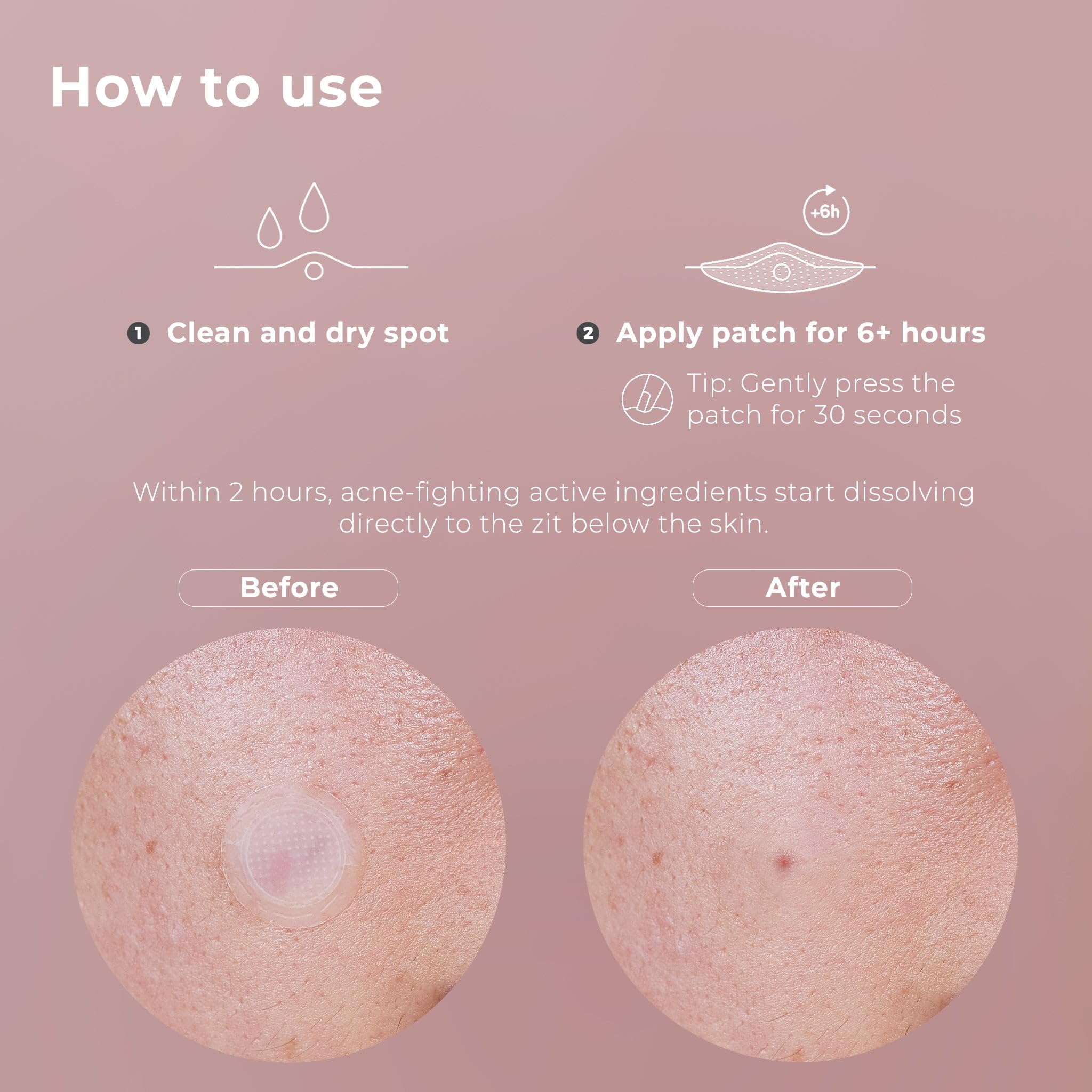 OMMA overnight acne patch applied to the face for nighttime care