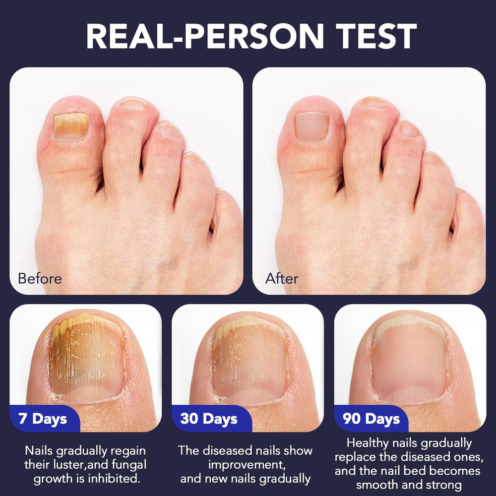 OMZOK Toenail Fungus Pen suitable for active lifestyles and gym routines.