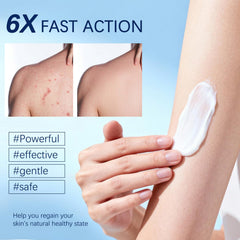 OUHENGTEK Folliculitis Cream on scalp area for targeted care