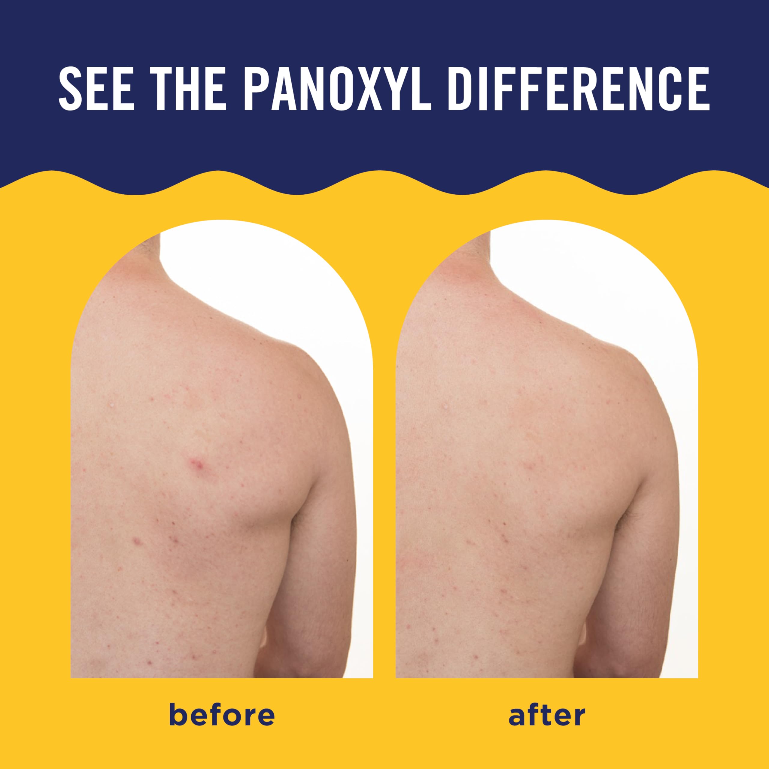 Rotate nozzle in action to reach difficult areas with PanOxyl.