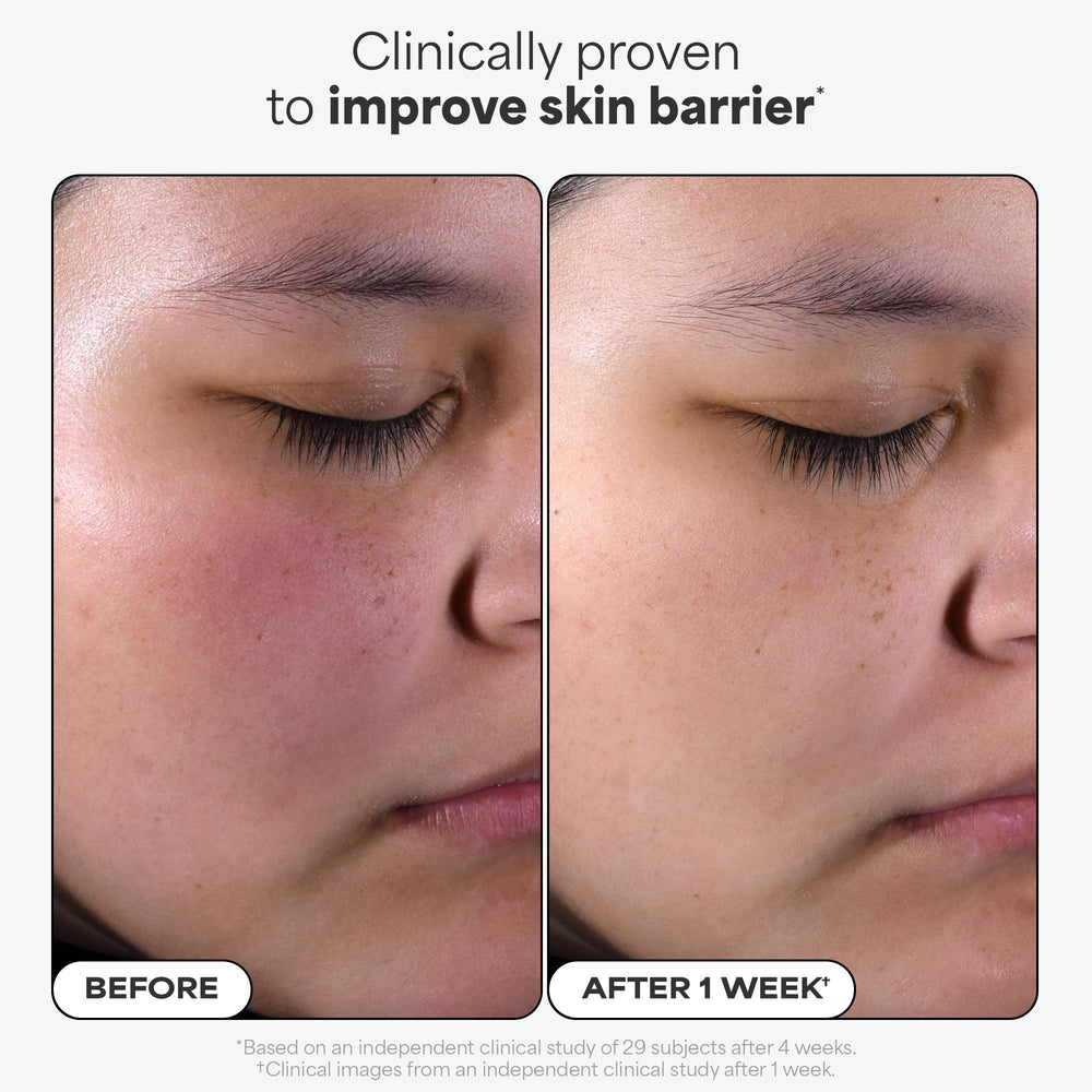 Brightened, even-toned look after using Paula's Choice 2% BHA exfoliant.