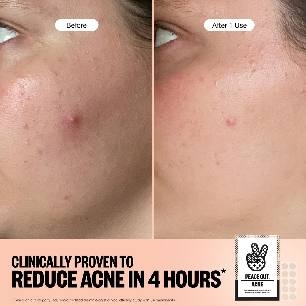 Peace Out Acne Healing Dots suitable for overnight use on face or body