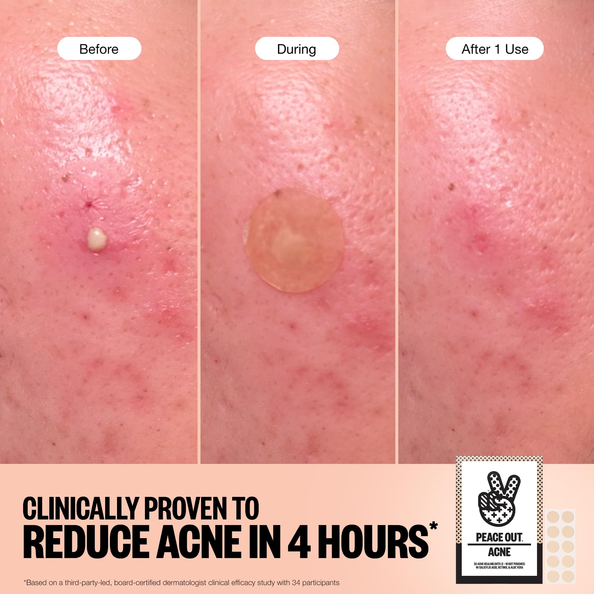 Peace Out Acne Healing Dots pack 60-count for convenient ongoing blemish care