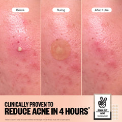Peace Out Acne Healing Dots pack 60-count for convenient ongoing blemish care