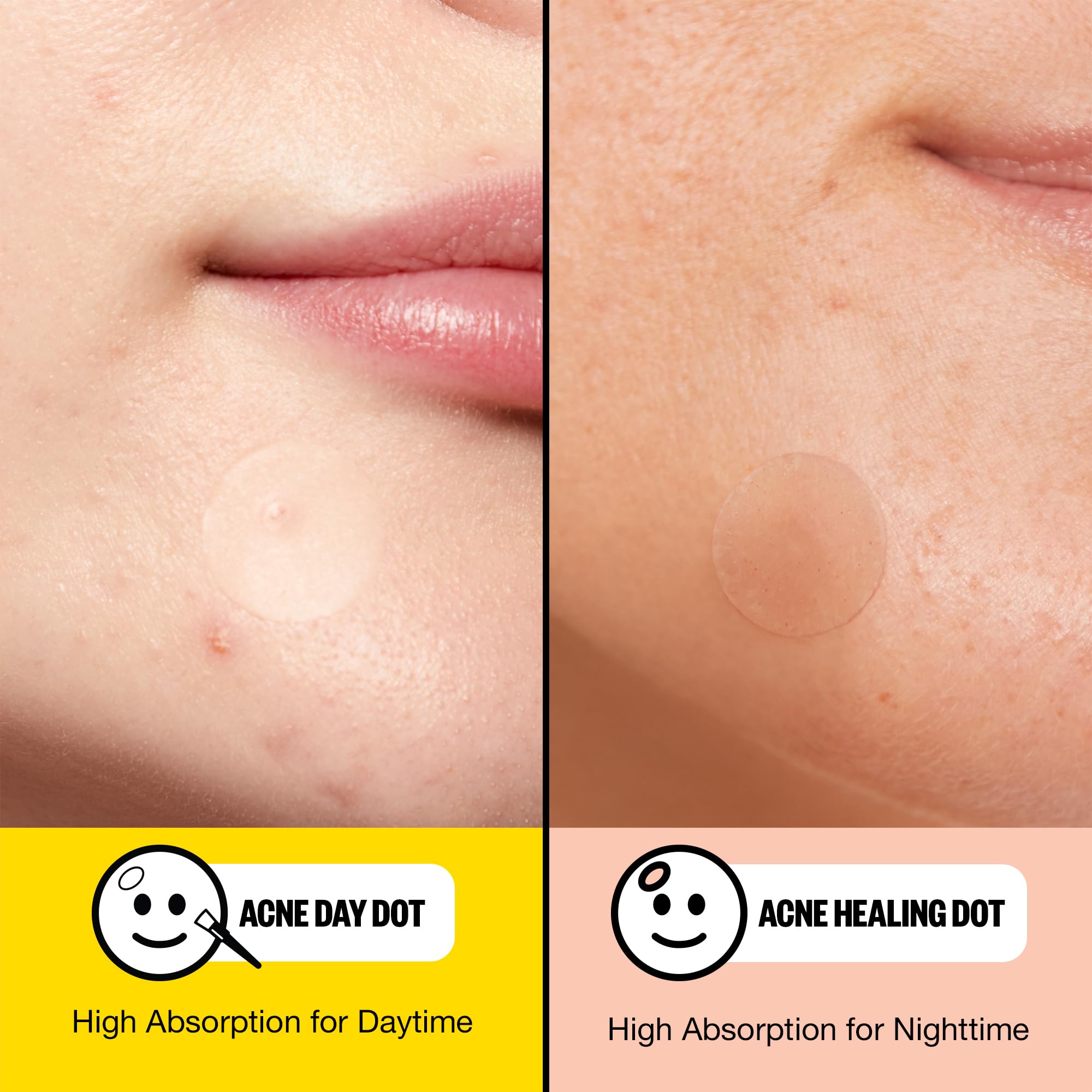 Peace Out hydrocolloid technology lifts impurities from pores