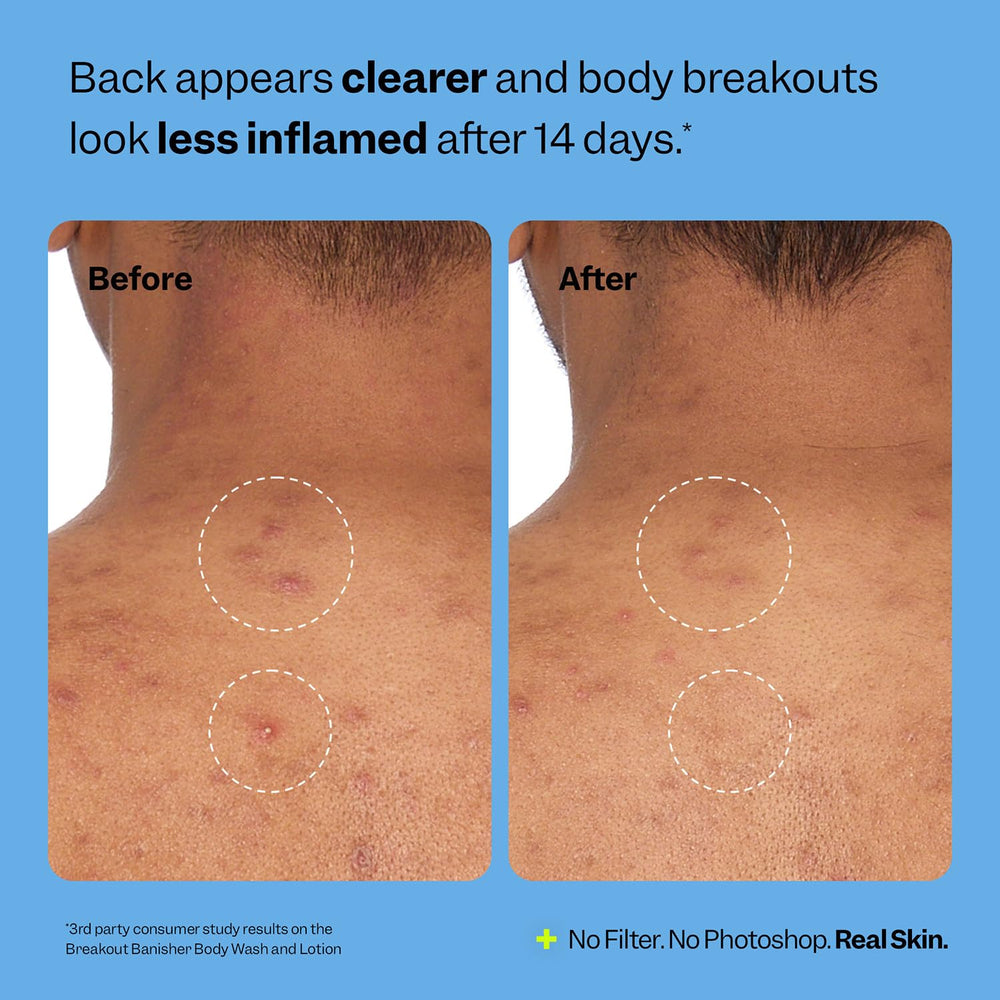 Peach Slices Breakout Banisher Body Wash with niacinamide for evening skin tone