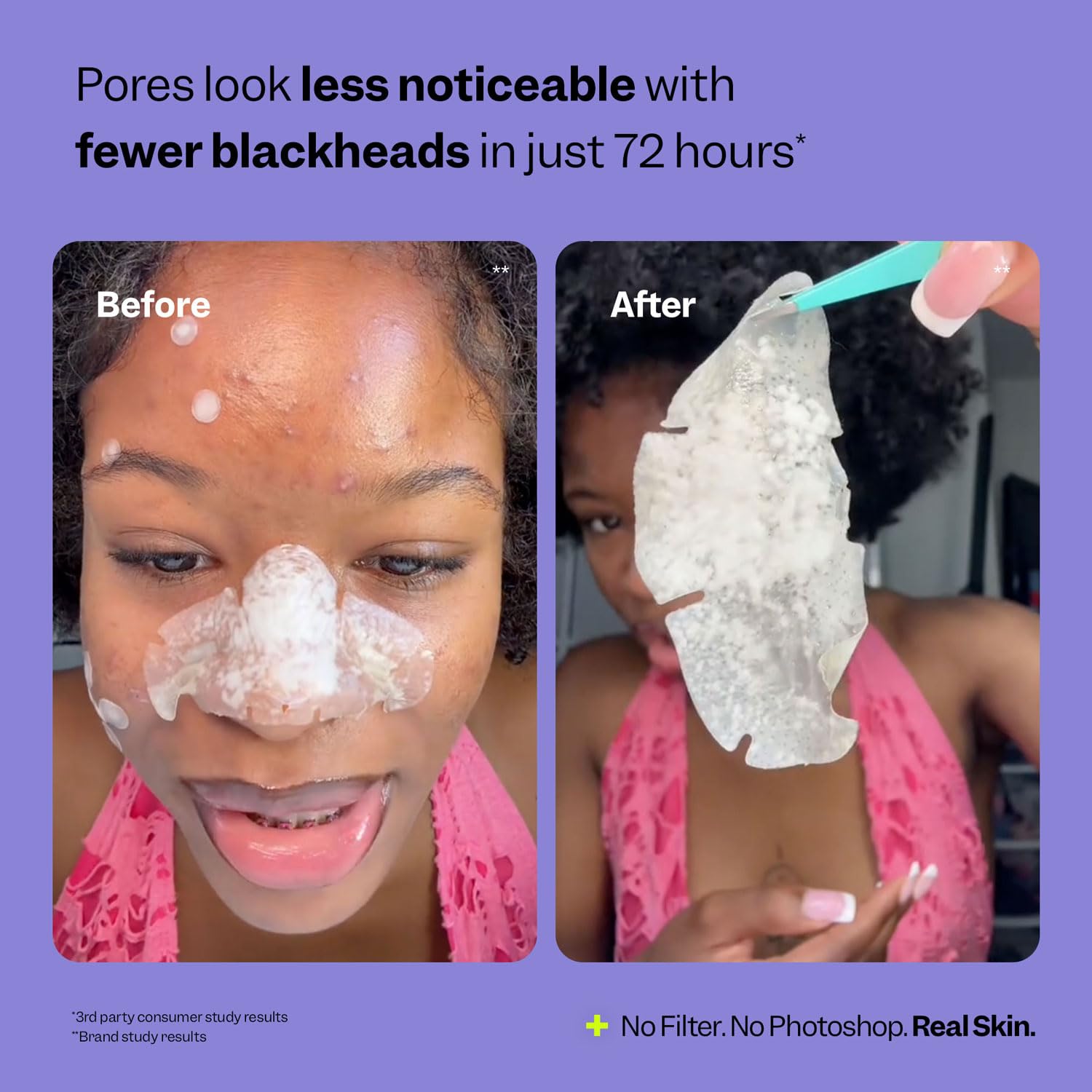 Peach Slices hydrocolloid technology draws out gunk while keeping skin comfortable.