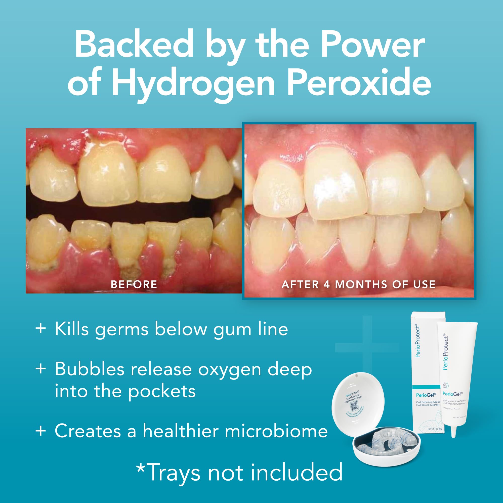 Home care routine with Perio Protect Perio Gel and gentle whitening.