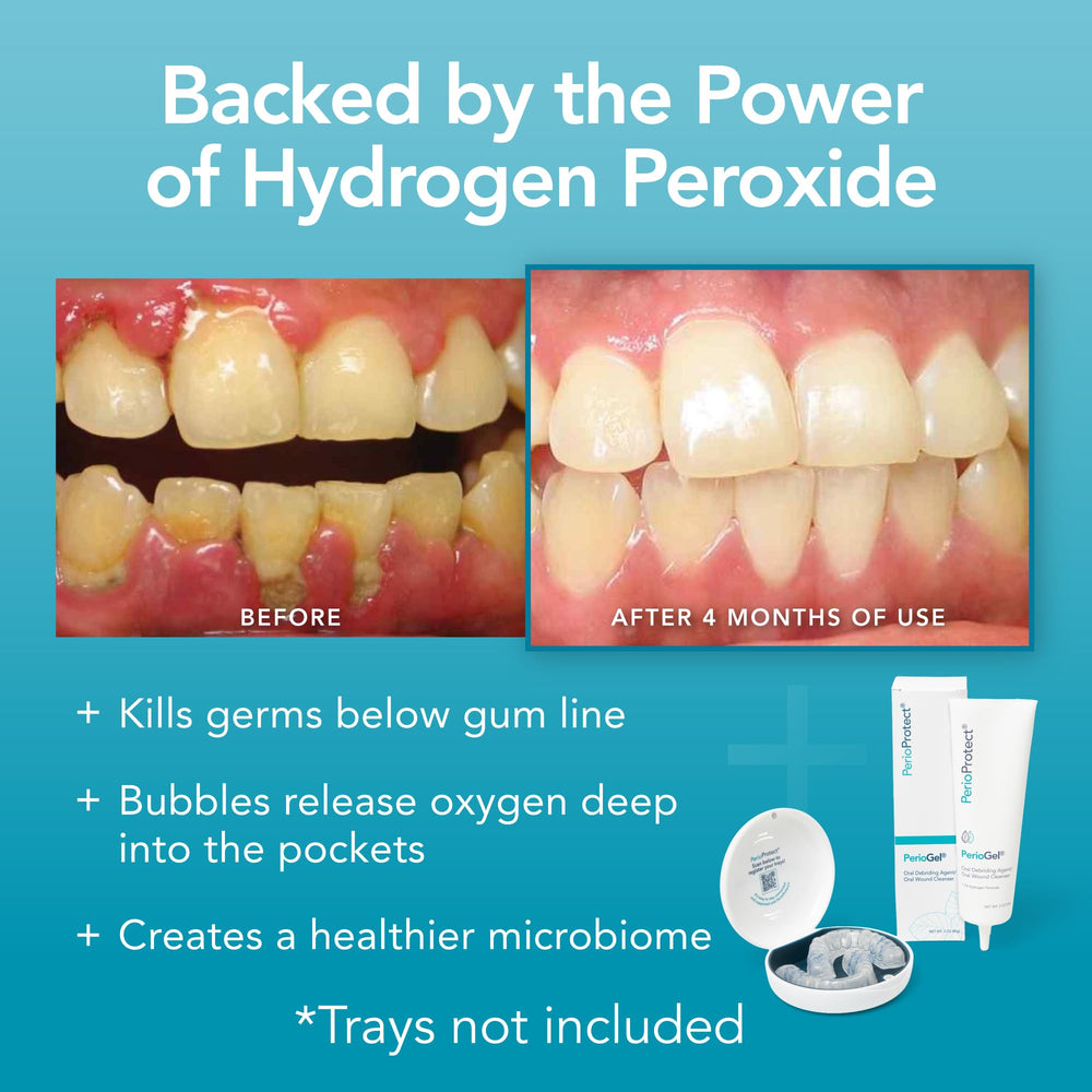 Home care routine with Perio Protect Perio Gel and gentle whitening.