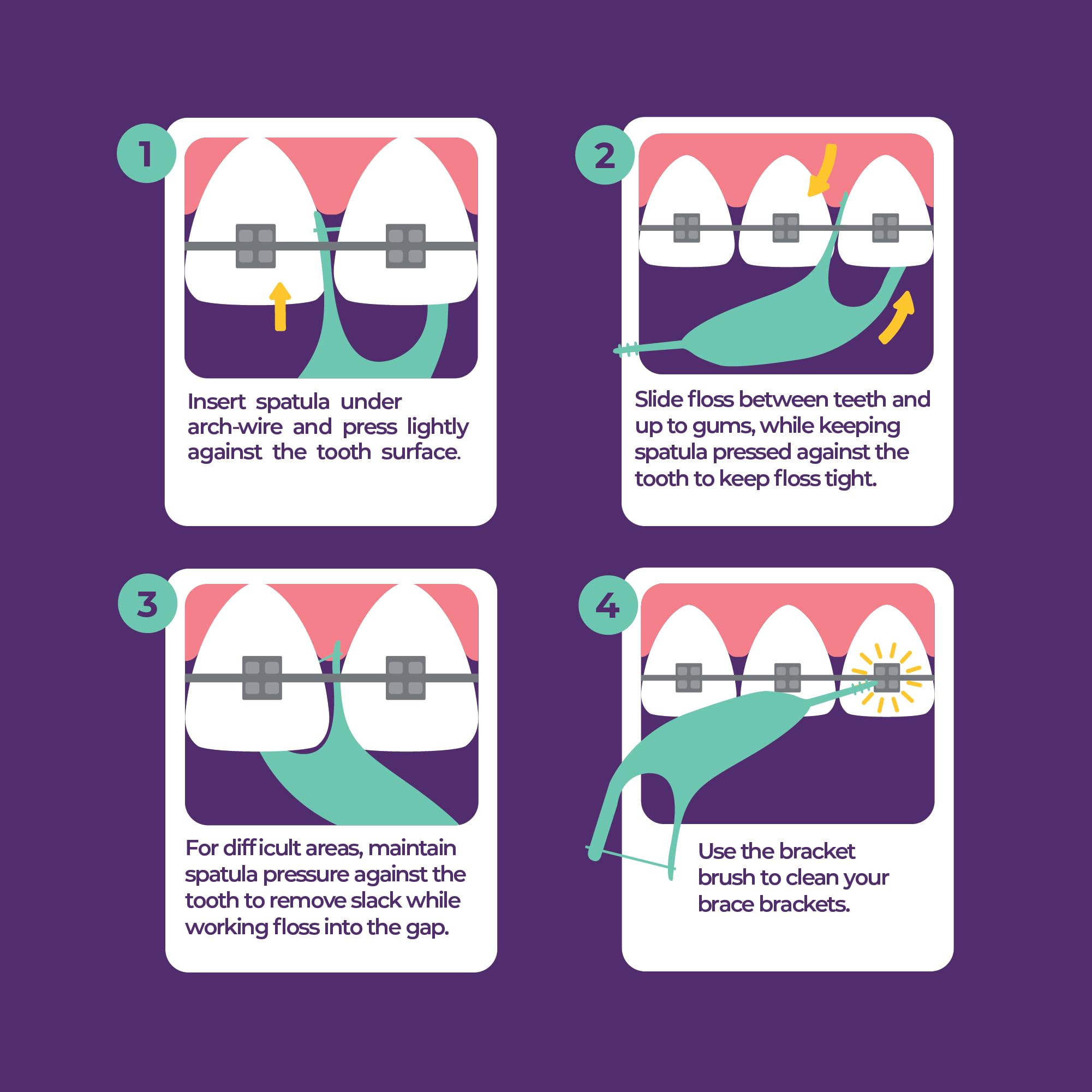 Platypus orthodontic flosser near brackets removes food particles safely.