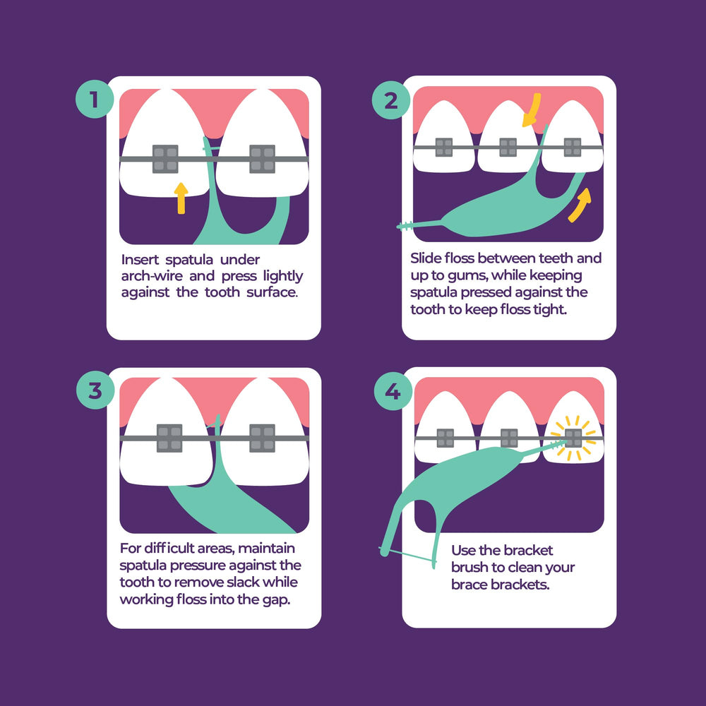 Platypus orthodontic flosser near brackets removes food particles safely.