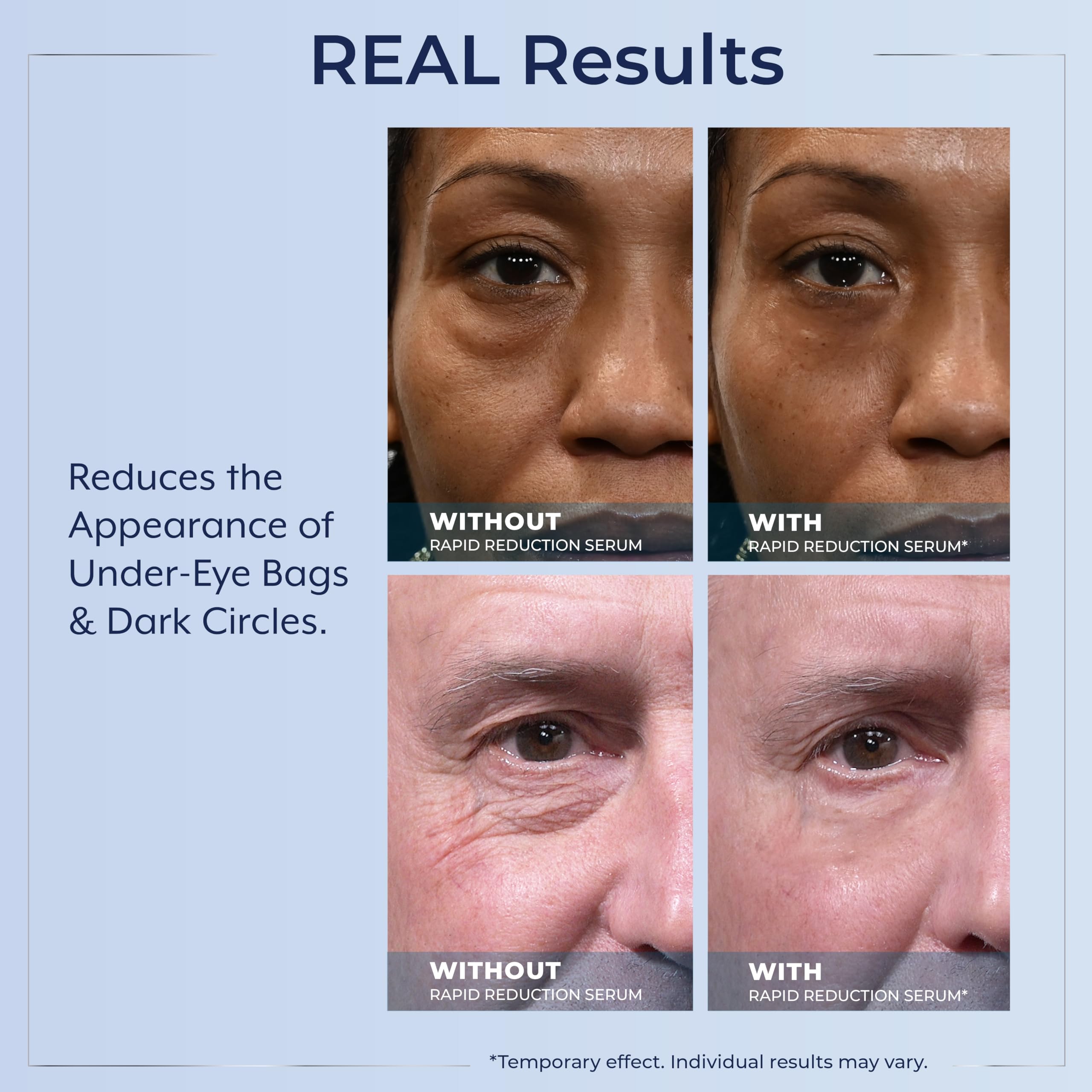 Plexaderm eye-area close-up showing brighter under-eye skin.