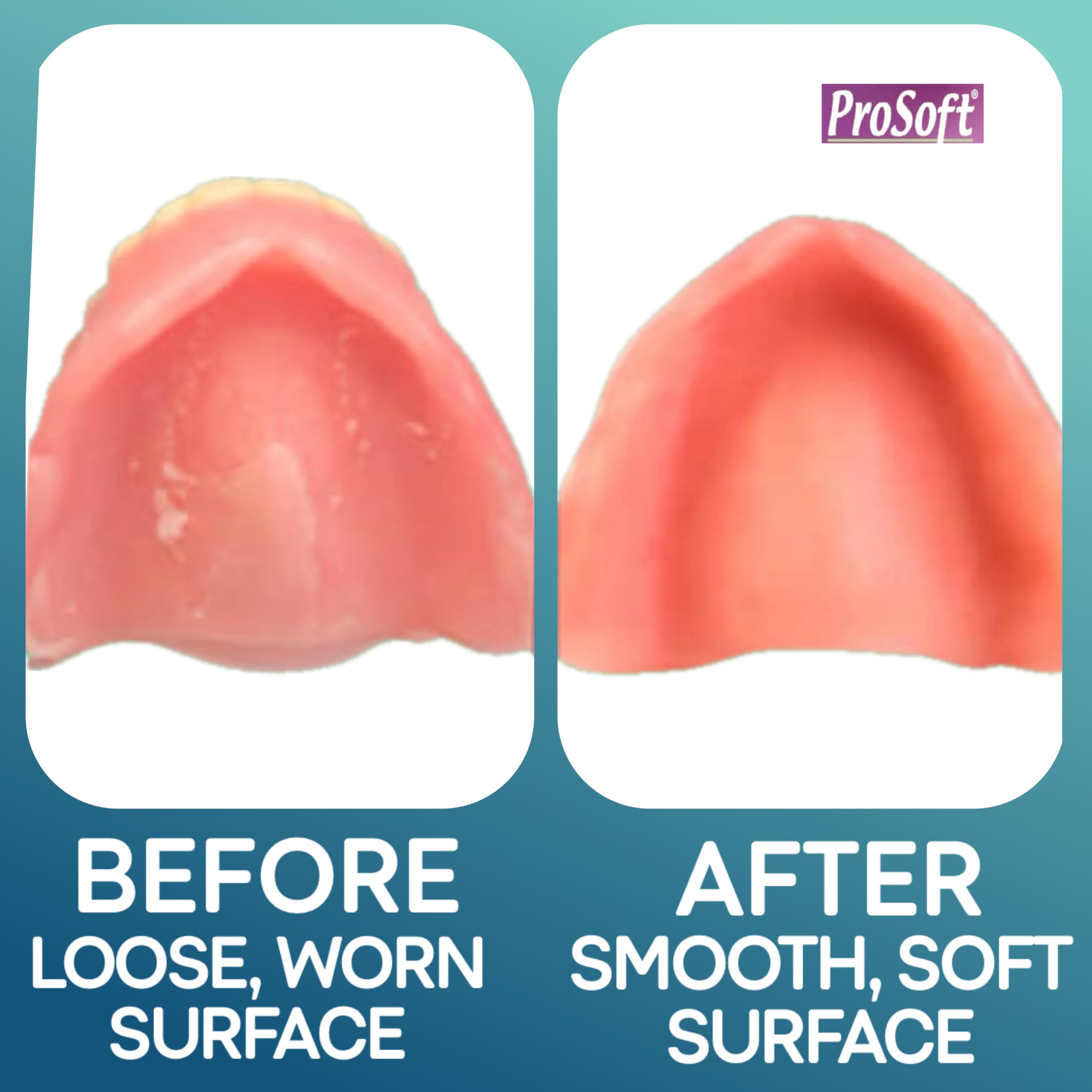 ProSoft Denture Reliner provides a precise gum impression for a smooth fit.