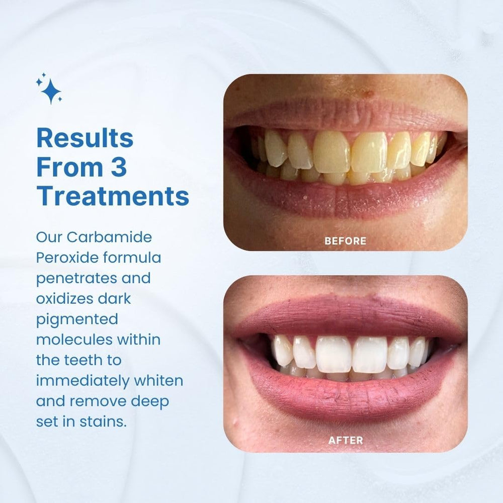 PurelyWHITE DELUXE moldable mouth trays for a comfortable whitening fit