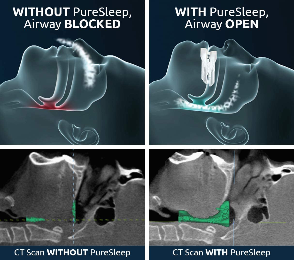PureSleep universal fit design adapts to most jaw shapes