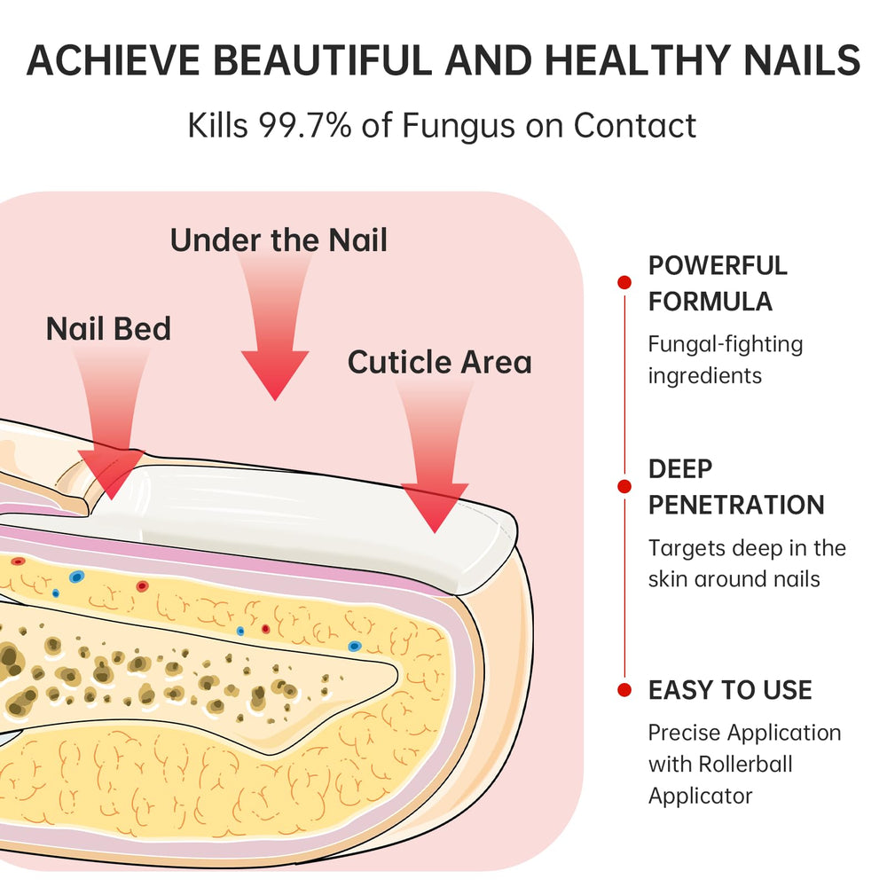 QQE Nail Fungus Treatment close-up shows nail discoloration for progress tracking.