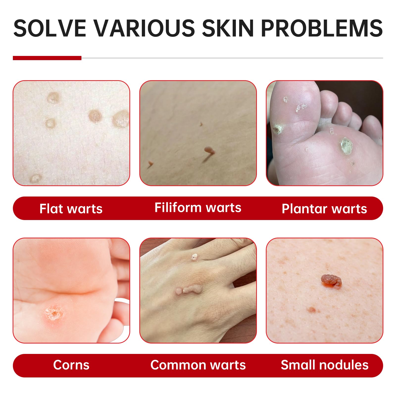 QQE wart remover liquid applied on wart for controlled treatment.