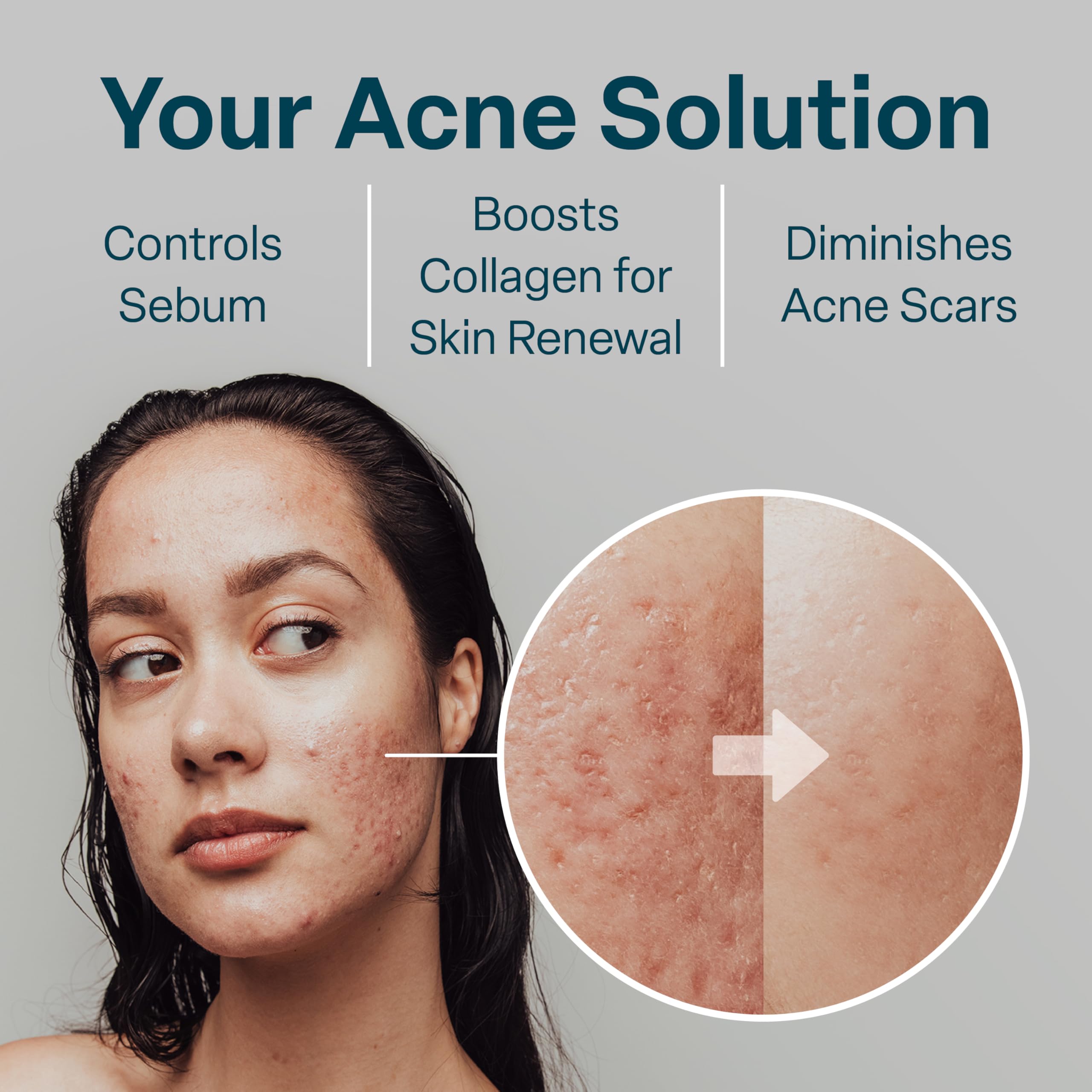 QRxLabs pads targeting bacne with exfoliation and balancing hydration.
