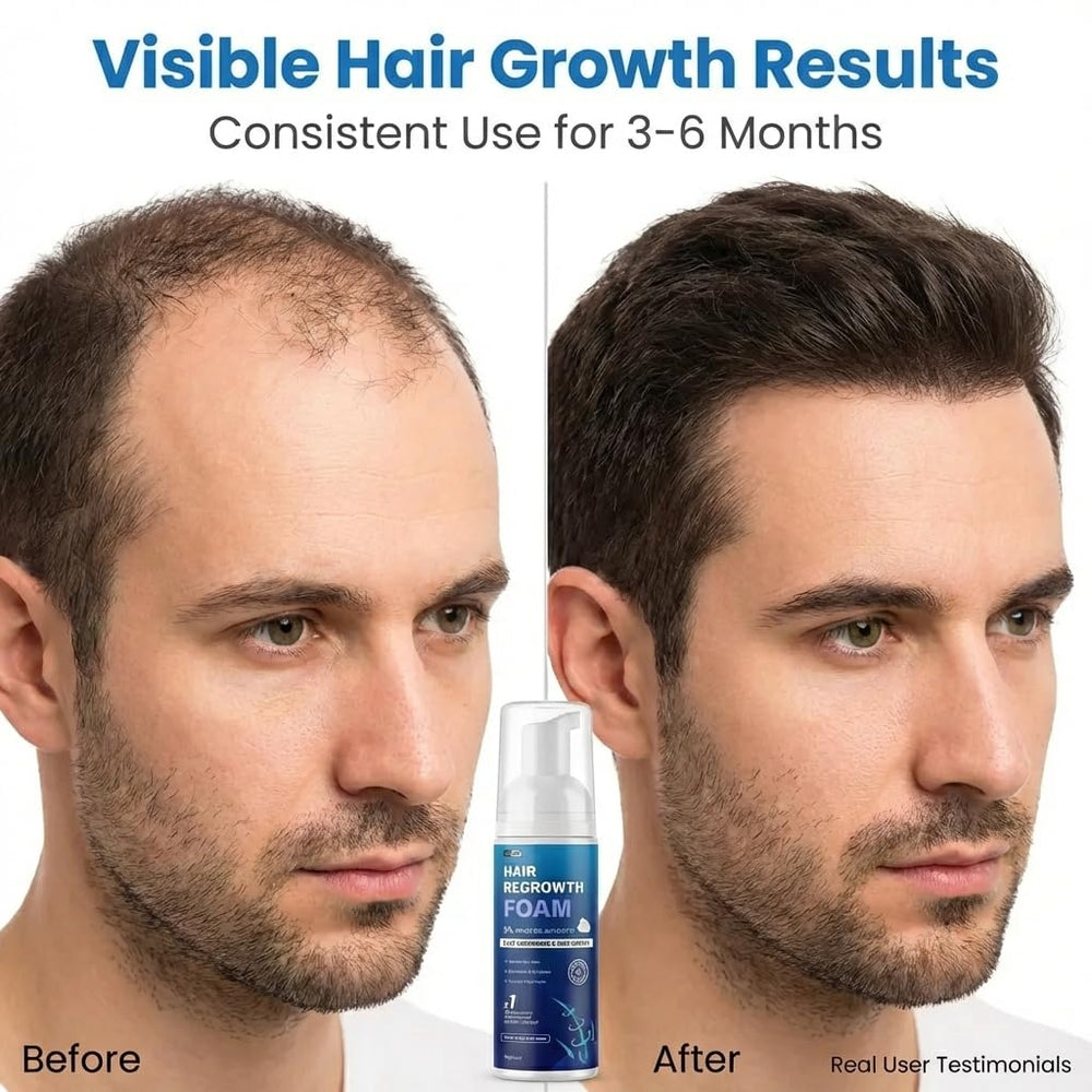 Quilom Minoxidil Foam targets crown and hairline thinning areas