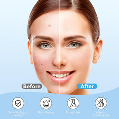 QUSTERE hydrocolloid patches absorb pore gunk and reduce visibility overnight.