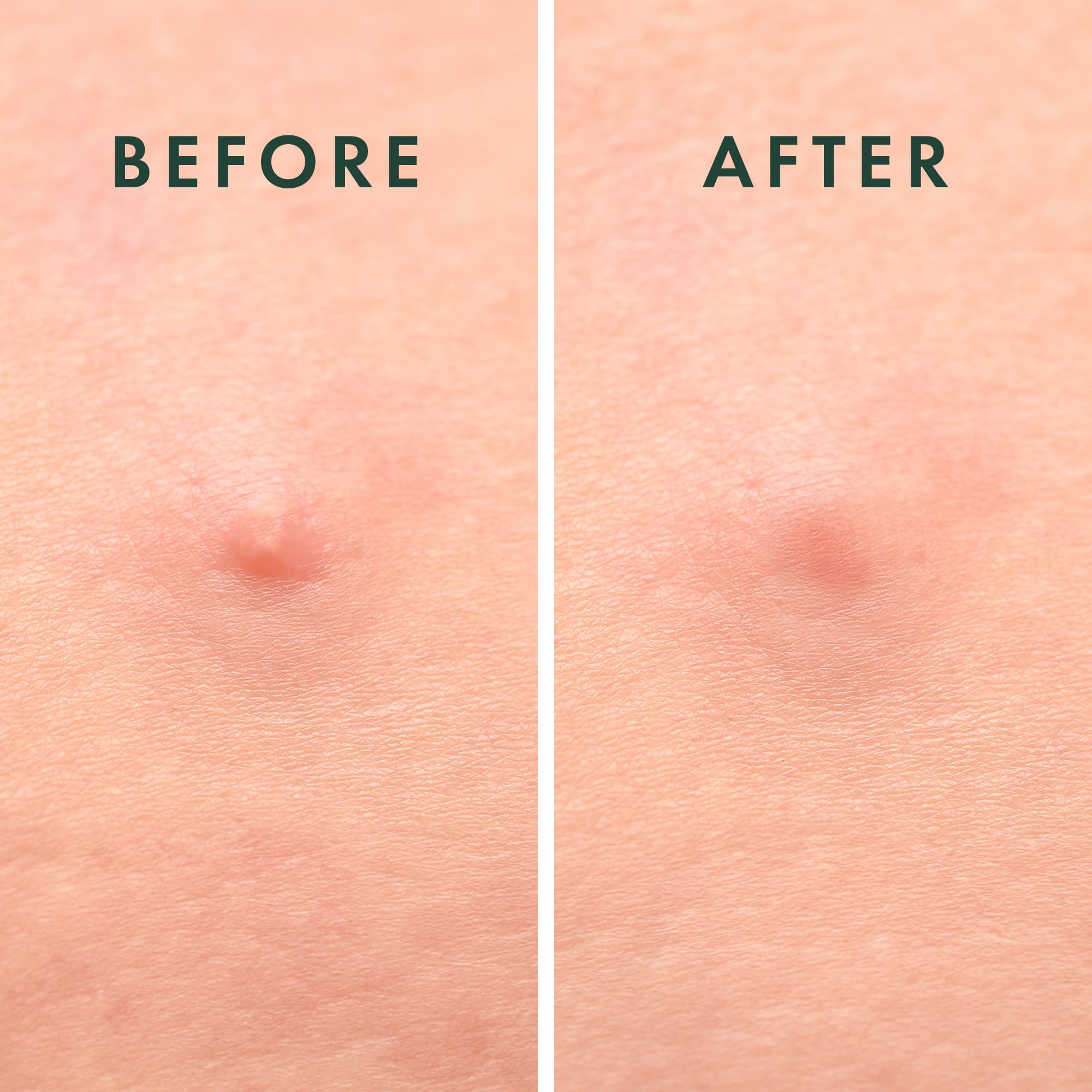 Rael protective patch shields blemishes from external irritants.
