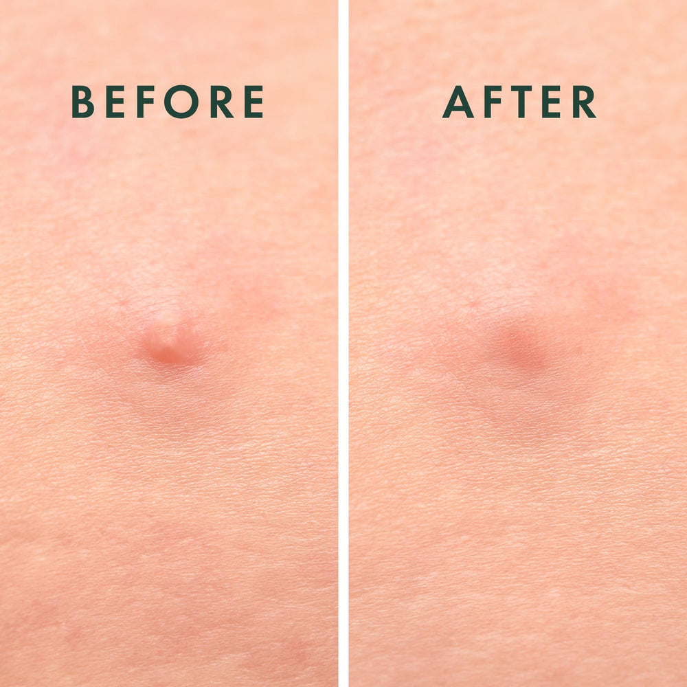 Rael protective patch shields blemishes from external irritants.