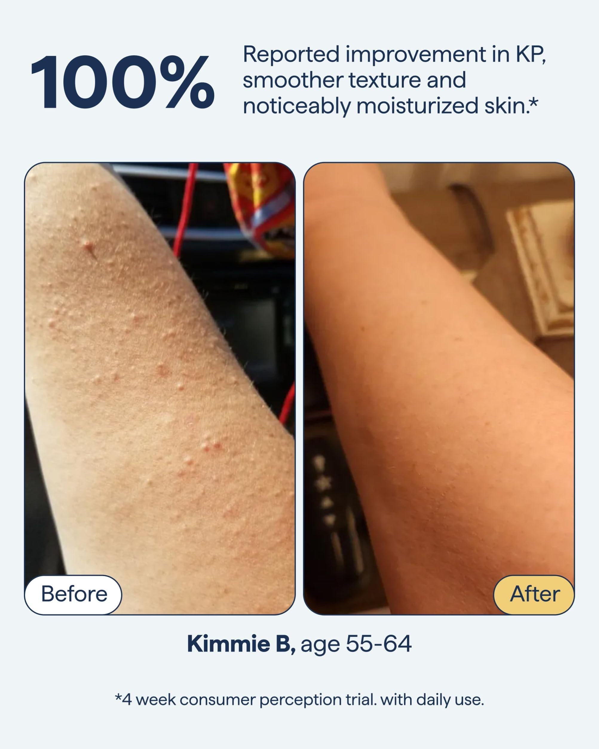 Remedy Science KP Exfoliating Body Moisturizer applied on arm indicates gentle use.
