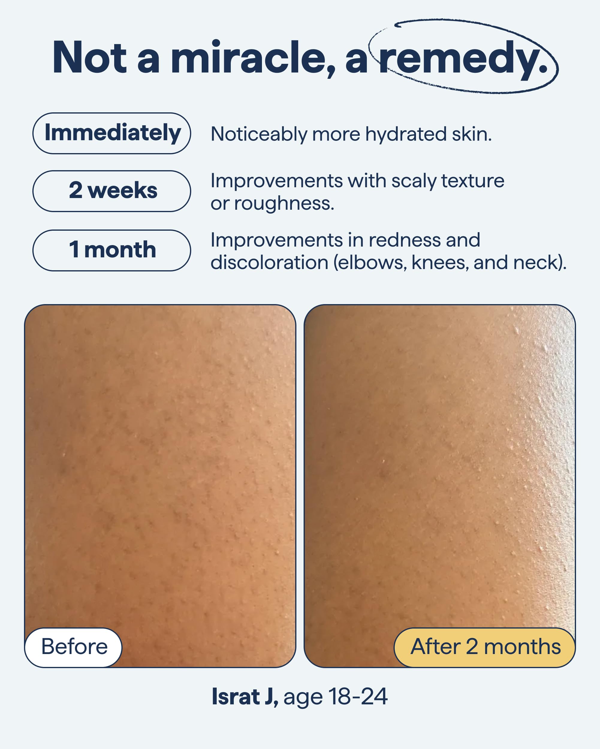 Remedy Science KP Exfoliating Body Moisturizer close-up highlights urea and lactic acid action.