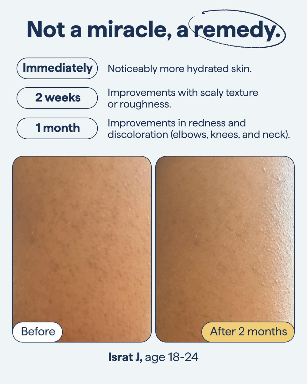 Remedy Science KP Exfoliating Body Moisturizer close-up highlights urea and lactic acid action.