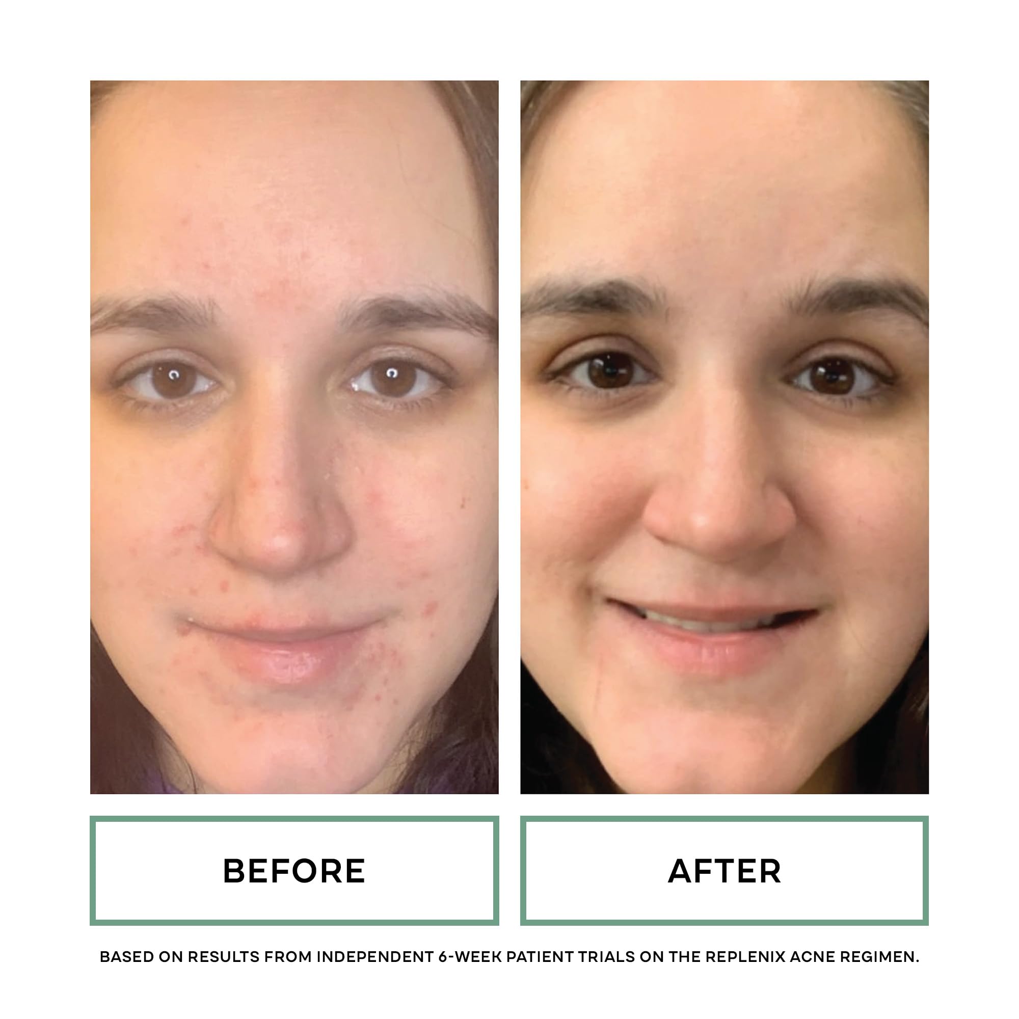 Replenix benzoyl peroxide face wash close-up pores detail