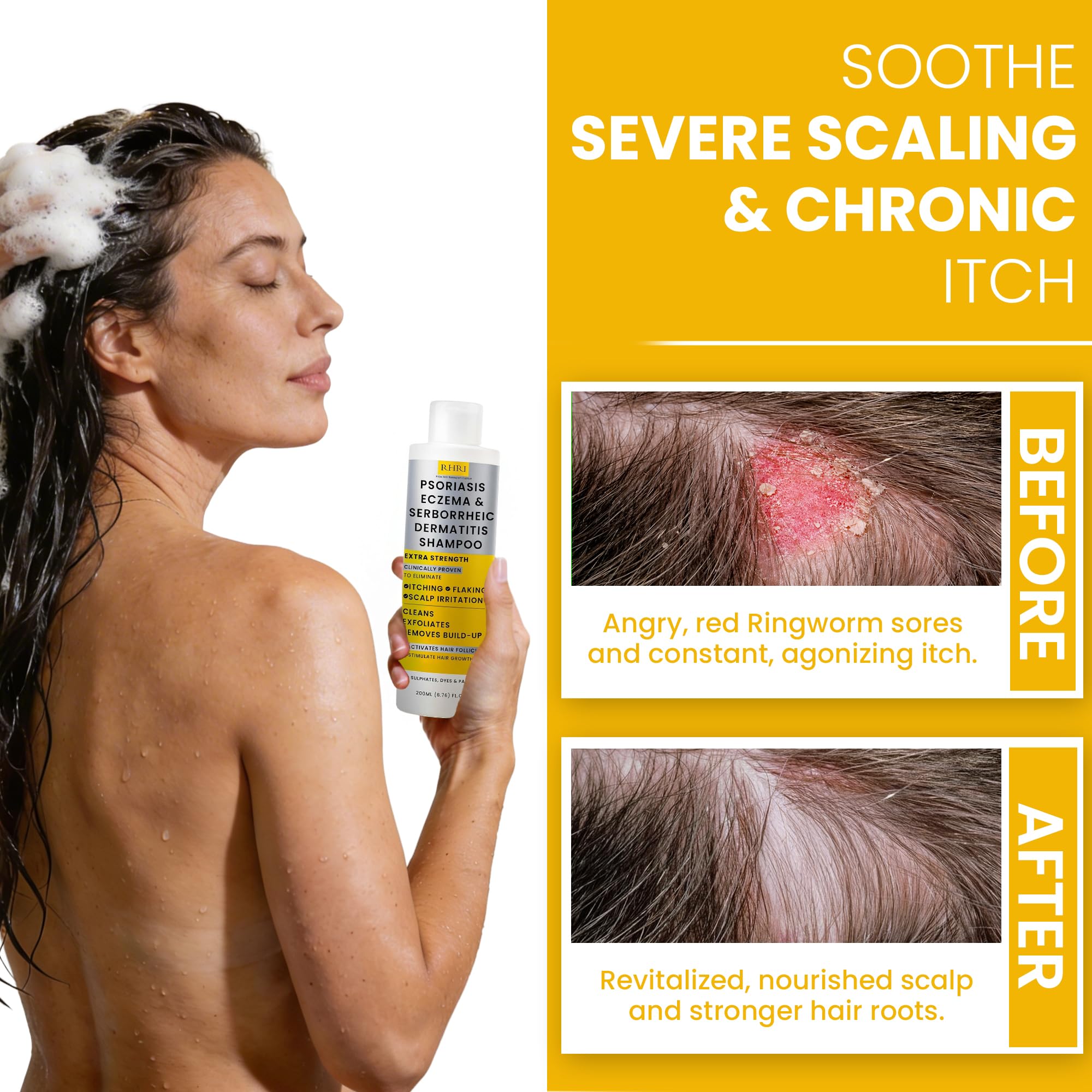 Rida Hair Psoriasis Shampoo bottle and pump for easy daily use.